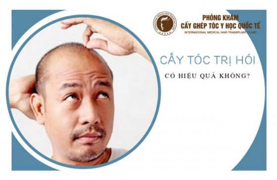 cấy tóc có thực sự hiệu quả không