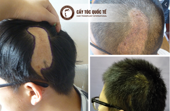 cấy tóc trên sẹo giá bao nhiêu