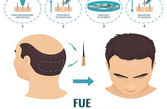 cấy tóc tự thân fue