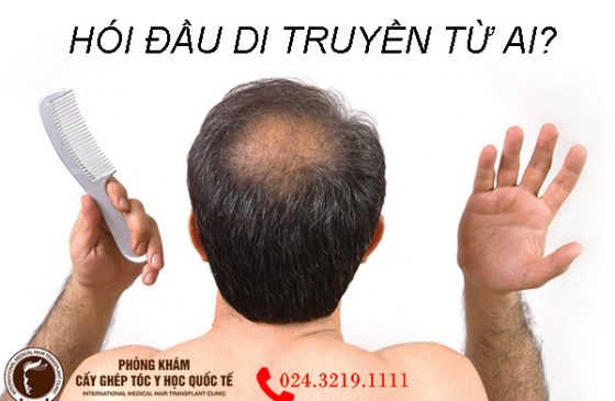 Hói đầu di truyền từ ai