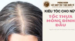kiểu tóc cho nữ bị hói đỉnh đầu