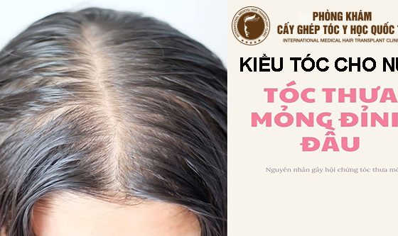 kiểu tóc cho nữ bị hói đỉnh đầu