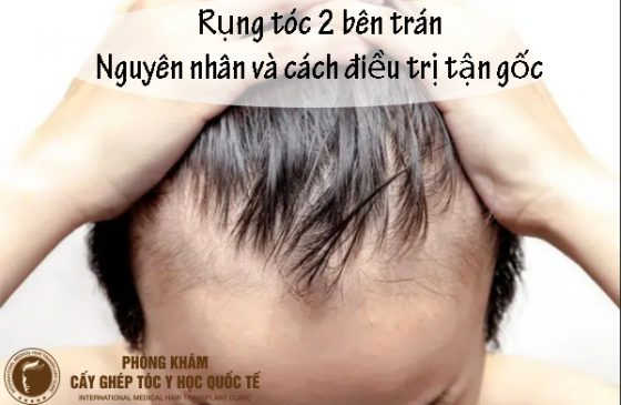 rụng tóc 2 bên trán
