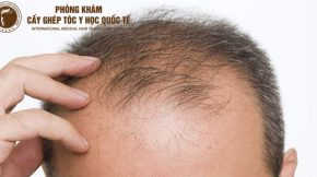 rụng tóc nhiều ở nam giới là bệnh gì