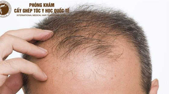rụng tóc nhiều ở nam giới là bệnh gì
