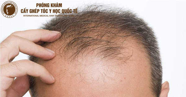 rụng tóc nhiều ở nam giới là bệnh gì