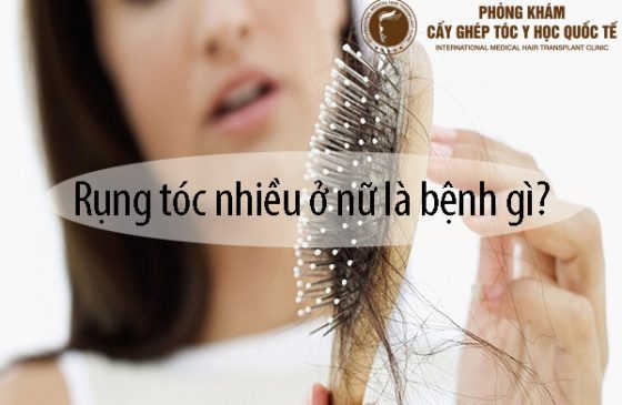 rụng tóc nhiều ở nữ là bệnh gì