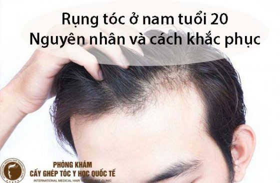 rụng tóc ở nam tuổi 20