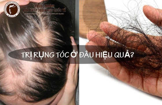 Trị rụng tóc ở đâu hiệu quả
