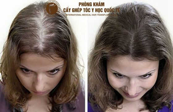 cách trị hói đầu ở phụ nữ