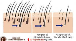 mất nang tóc
