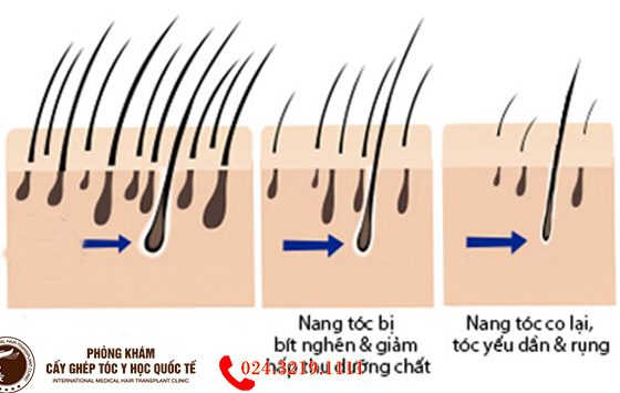 mất nang tóc