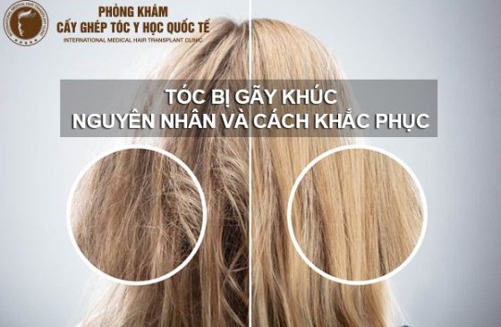 Tóc bị gãy khúc