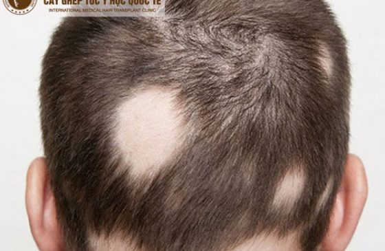 tóc rụng từng mảng có mọc lại không