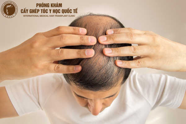 Rụng tóc ở đỉnh đầu nam giới  Nguyên nhân và hướng khắc phục Phần 2