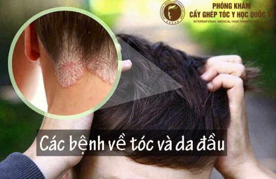 các bệnh về tóc và da đầu