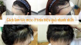 cách làm tóc mọc ở trán