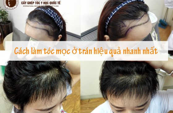 cách làm tóc mọc ở trán