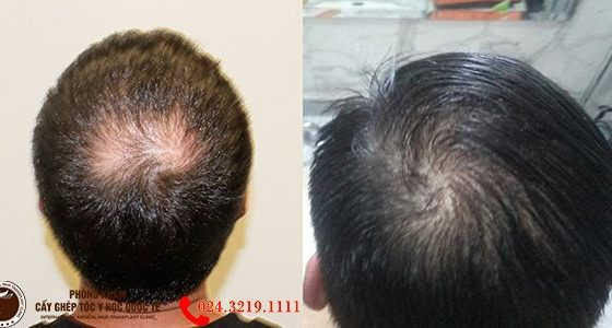 cách mọc tóc ở đỉnh đầu