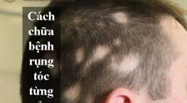 cách chữa bệnh rụng tóc từng mảng