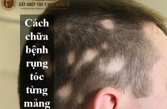 cách chữa bệnh rụng tóc từng mảng