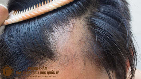 cách chữa bệnh rụng tóc từng mảng