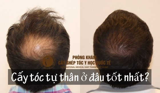 cấy tóc tự thân ở đâu tốt nhất