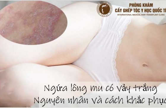 Ngứa lông mu có vảy trắng