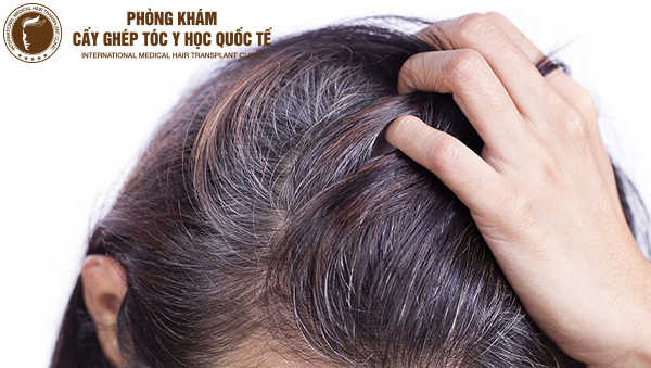 Nguyên nhân tóc bạc sớm ở người trẻ tuổi