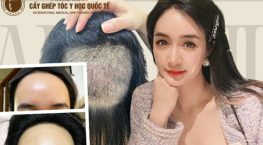trán cao muốn mọc tóc
