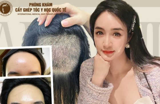trán cao muốn mọc tóc