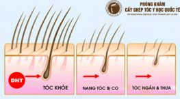 chân tóc bị teo