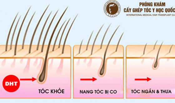 chân tóc bị teo