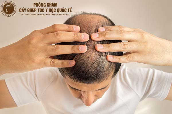 hiện tượng rụng tóc nhiều ở nam giới