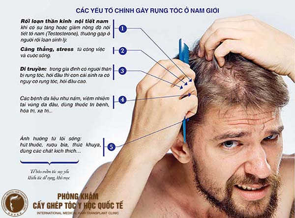 Hiện tượng rụng tóc nhiều của nam giới: Nguyên nhân và cách khắc phục