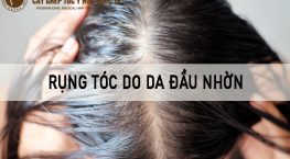 rụng tóc do da nhờn