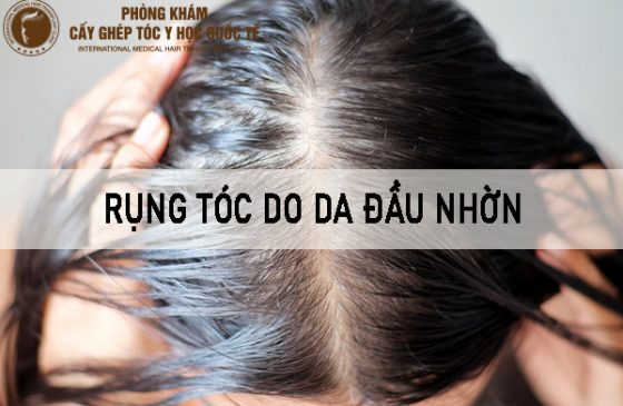 rụng tóc do da nhờn