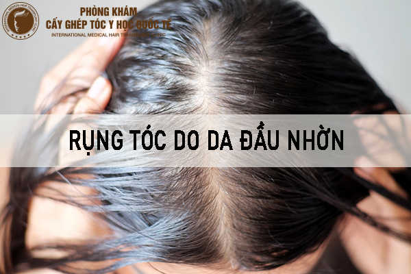 14 Nguyên nhân gây rụng tóc nhiều ở nữ giới & Cách chữa trị