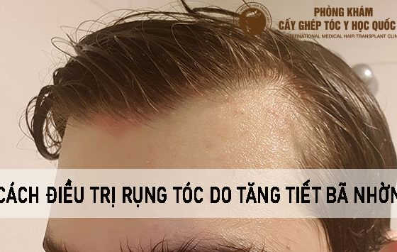 rụng tóc do tăng tiết bã nhờn