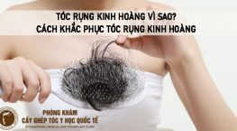 tóc rụng kinh hoàng vì sao