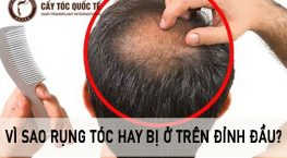 vì sao rụng tóc hay bị ở trên đỉnh đầu