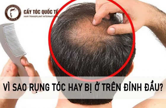 vì sao rụng tóc hay bị ở trên đỉnh đầu