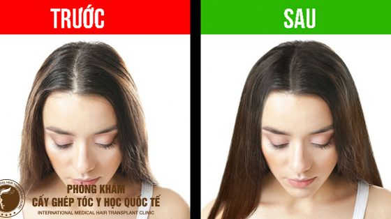 cách giúp tóc nhiều và dày