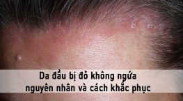 da đầu bị đỏ không ngứa