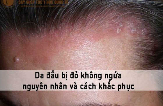 da đầu bị đỏ không ngứa