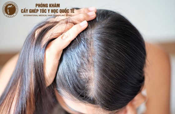 Đầu rụng ít tóc