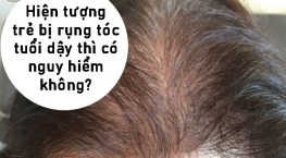 hiện tượng trẻ dậy thì bị rụng tóc có nguy hiểm không
