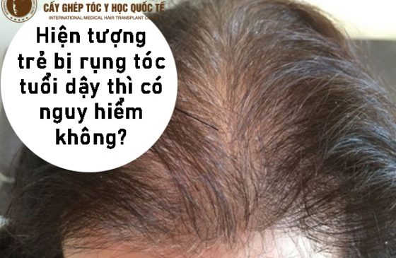 hiện tượng trẻ dậy thì bị rụng tóc có nguy hiểm không