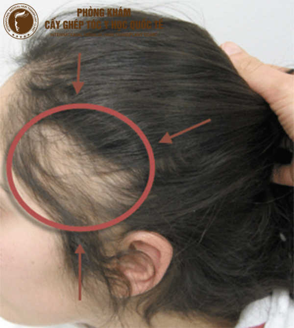 hiện tượng trẻ dậy thì bị rụng tóc có nguy hiểm không