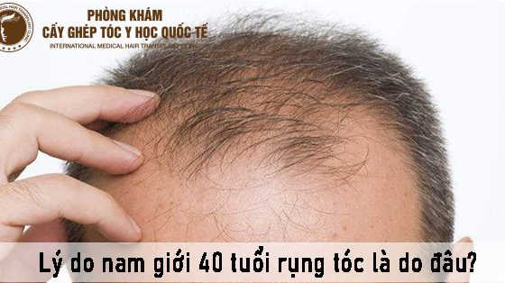 lý do nam giới 40 tuổi rụng tóc là do đâu